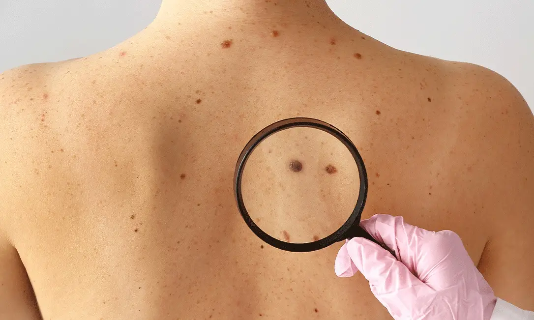 Lupa identificando um possível cancer de pele